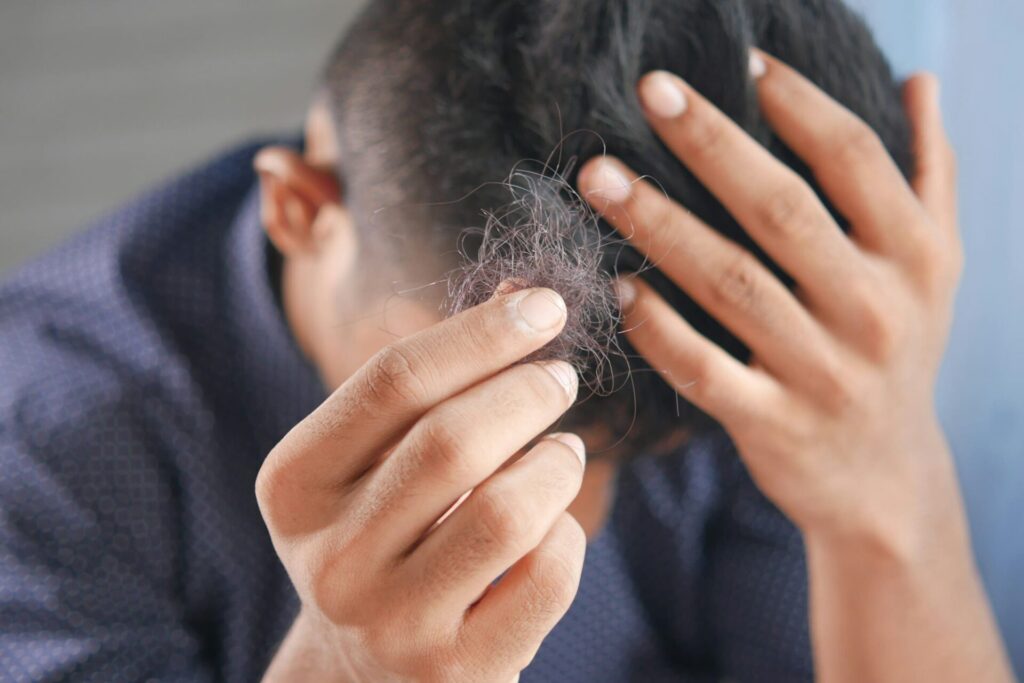 L'alopecia è una malattia genetica