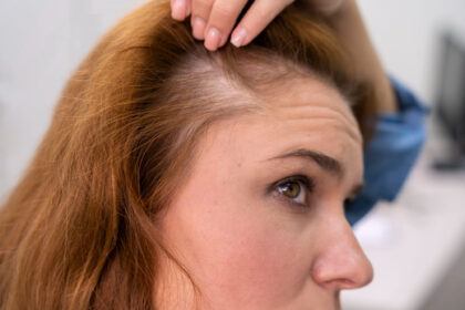 Perché cadono i capelli